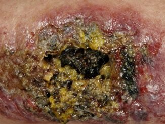 Dr. McCullough: “Flesh-Eating Bacteria Crisis Spirals Out of Control”