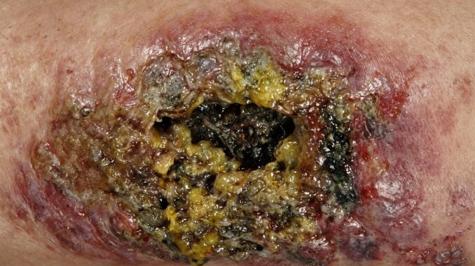 Dr. McCullough: “Flesh-Eating Bacteria Crisis Spirals Out of Control”