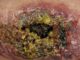 Dr. McCullough: “Flesh-Eating Bacteria Crisis Spirals Out of Control”